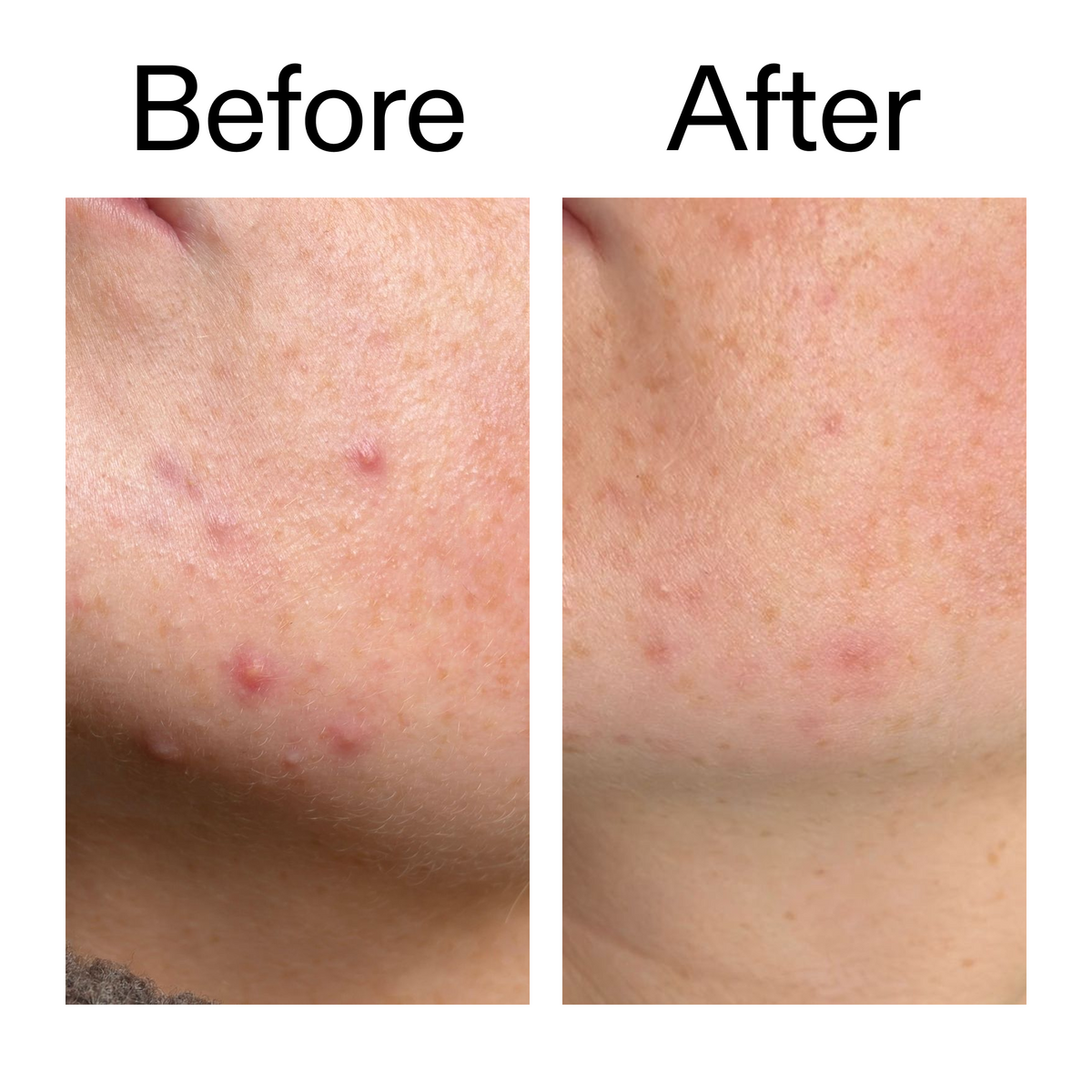 10-azelaic-acid-serum-for-redness-relief-h6 B_A_1_PPAGE.png