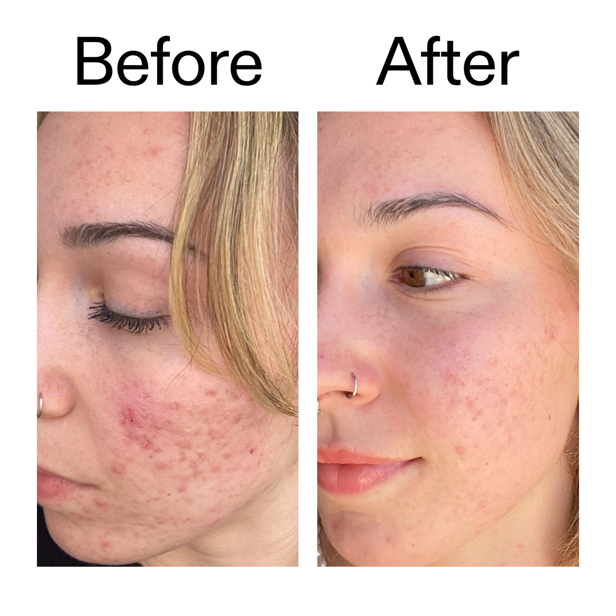 10-azelaic-acid-serum-for-redness-relief-h6 B_A_2_PPAGE.png