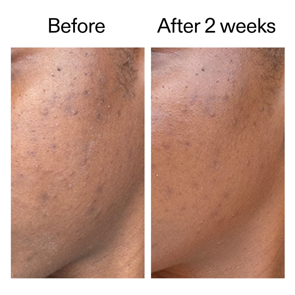 360-acne-clearing-duo-g7 DIOICB_A2000x2000.jpg