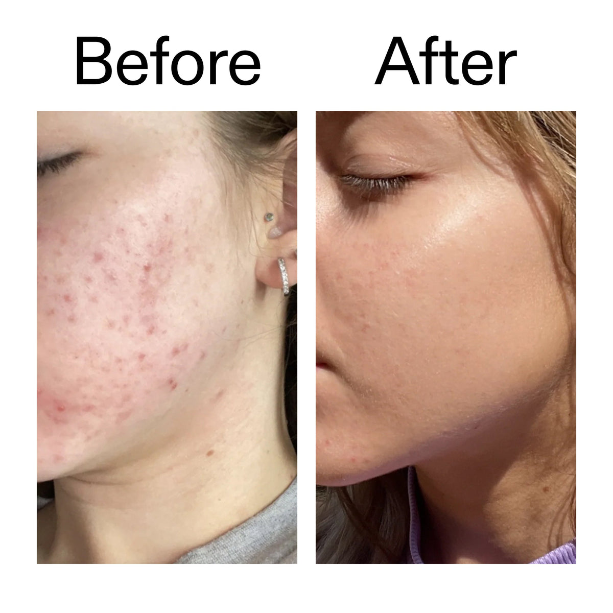 10-niacinamide-serum-duo-u7 Niacinamide_Serum_Before_After_2000x2000_bde32455-9e7d-448e-b053-bef41504f0a9.jpg