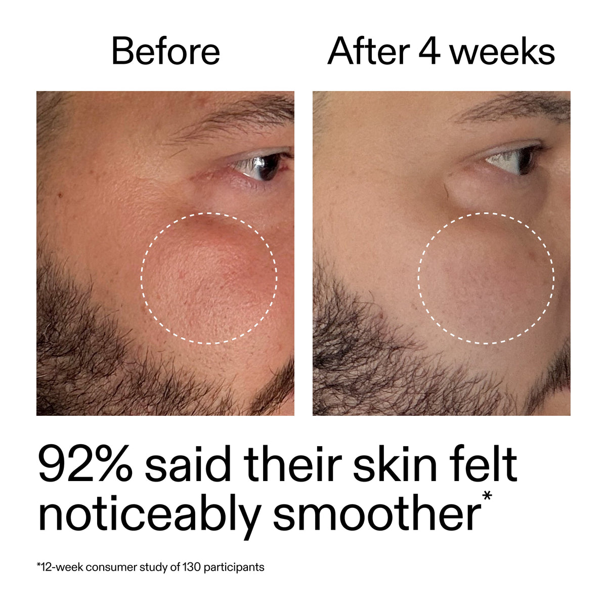 starter-retinol-serum-duo-y1 StarterRetinol_BeforeAfter_Claim3_2000x2000_458243a8-bbb0-4e5d-a274-29c7766d339b.jpg